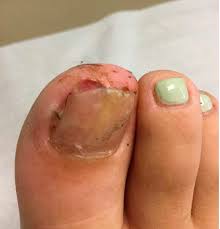what s under my toenail mdedge