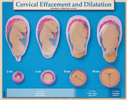 Cervical Effacement And Dilatation Chart