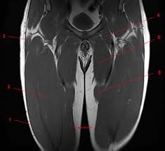 The upper limb muscles fall into three groups. Mri Of The Thigh Detailed Anatomy Superior Part W Radiology