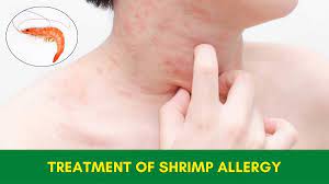 treatment of shrimp allergy in ayurveda