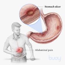 stomach ulcer top 2 causes