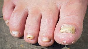 nail fungus causes symptoms