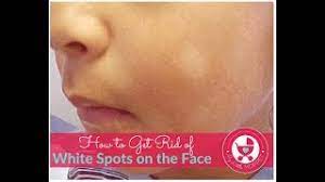 white spots on the face