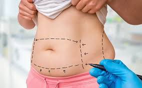 liposuction and tummy tuck