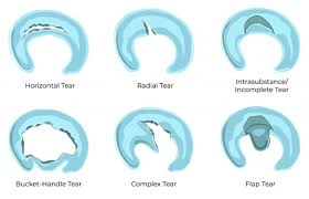 surgical repair of meniscus tears