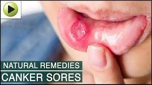 treat canker sores home remes