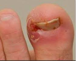 ingrown toe nails karr foot leg center