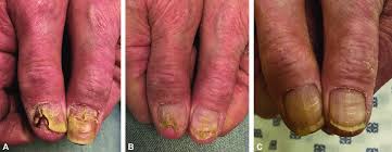 nail changes in a patient with ad