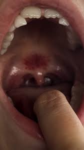 mouth rash above tonsils with pic