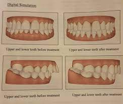 The higher the amount of overbite, the longer it will take to fix it. 9mm Overjet 3 Orthodontist Opinions Need Advice Braces