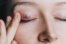 how to get rid of a stye the right way