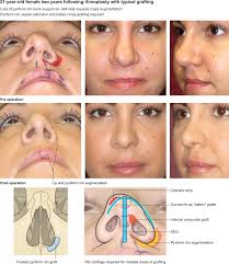 rhinoplasty in cleft lip and palate