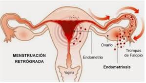 Endometriosis is a condition where tissue similar to the lining of the womb starts to grow in other places, such as the ovaries and fallopian tubes. Sintomas De La Endometriosis Y Como La Fisioterapia Puede Ayudar En Esta Patologia Virginia Moreno Fisioterapia