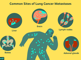 If you had chosen a different language to study, what might it. Common Sites Of Lung Cancer Metastases