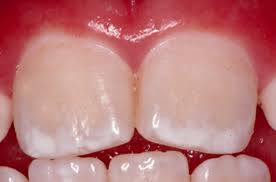 Dental fluorosis causes dental fluorosis symptoms dental fluorosis prevention. Dental Fluorosis Causes Prevention Symptoms Dental Fluorosis Treatment