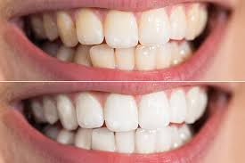 what is zoom teeth whitening know your