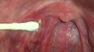 Image result for tonsil stones