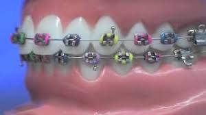 Use clean linen or unused socks as storage for the ax chunks. How To Use Wax For Your Braces Advice From Splash Orthodontics
