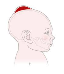 newborn cephalohematoma causes