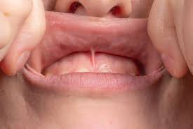 macro of upper lip frenulum of a mouth