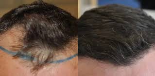 how to fix a messed up hairline