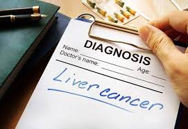 How will i know if my prostate cancer returns? Treating Colon Cancer That Has Spread To The Liver A Team Approach Johns Hopkins Medicine
