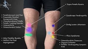 knee pain location chart learn the