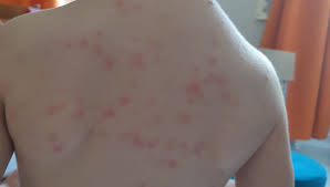 Les cas de varicelle se multiplient en Pays de Savoie