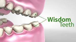 You're also more likely to have issues with these molars than with any other teeth. Get Wise About Wisdom Teeth Youtube