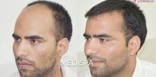 hair transplant cost in canberra