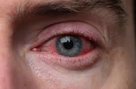can optometrists treat eye infections