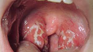 rash and sore throat pictures causes