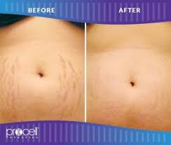 stretch mark removal about face and body