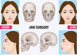 maxillo surgery