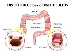 how to treat diverticulitis effectively