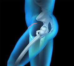 minimally invasive direct anterior hip