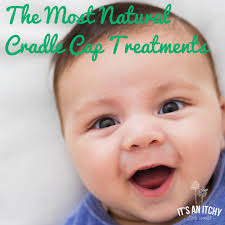 the most natural cradle cap treatments