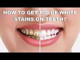 Is it ok to whiten teeth with braces? Pin On White Teeth Quickly Easily