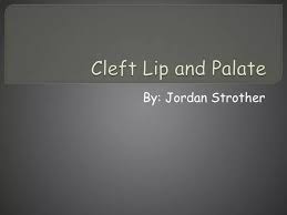 ppt cleft lip and palate powerpoint