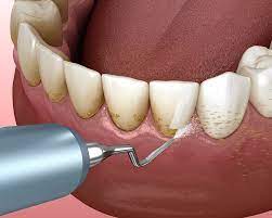 gum disease dentist in spokane valley
