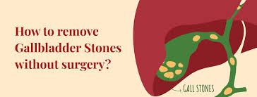 how to remove gallbladder stone without
