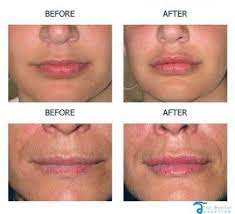 lip augmentation lip lift enhancements