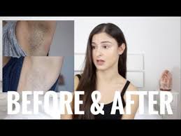 Excess hair growth (hirsutism) slows when high androgen levels decrease. Body Hair Removal Update 1 Laser Hair Removal Results And Pcos Youtube