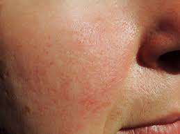 acne rosacea treatment 6 reasons not