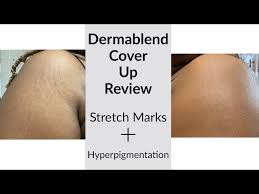 how to conceal stretch marks