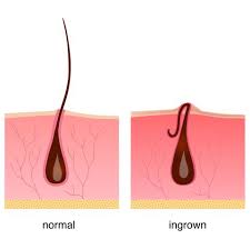 A common reason the hair becomes trapped is because the follicle is clogged with dead skin. How To Get Rid Of An Ingrown Hair Ingrown Hair Removal Tips