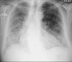 Pulmonary fibrosis is one of nearly 200 chronic lung conditions that are characterized by respiratory failure is the most common cause of death in pulmonary fibrosis patients but early diagnosis and. Que Es La Fibrosis Pulmonar Sintomas Pronostico Y Mas