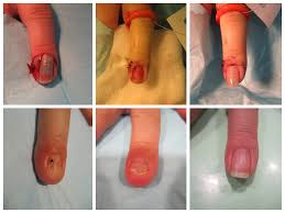 surgical repair of fingernail injury