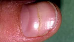 split nail causes treatment and