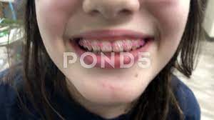 Tween girl happy with braces on | Stock Video | Pond5